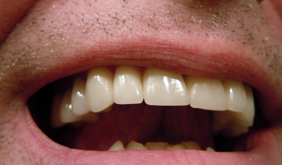 सपने में दांत गिरना