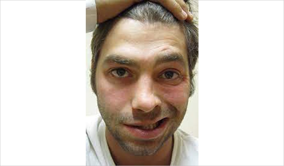 बेल्स पाल्सी3