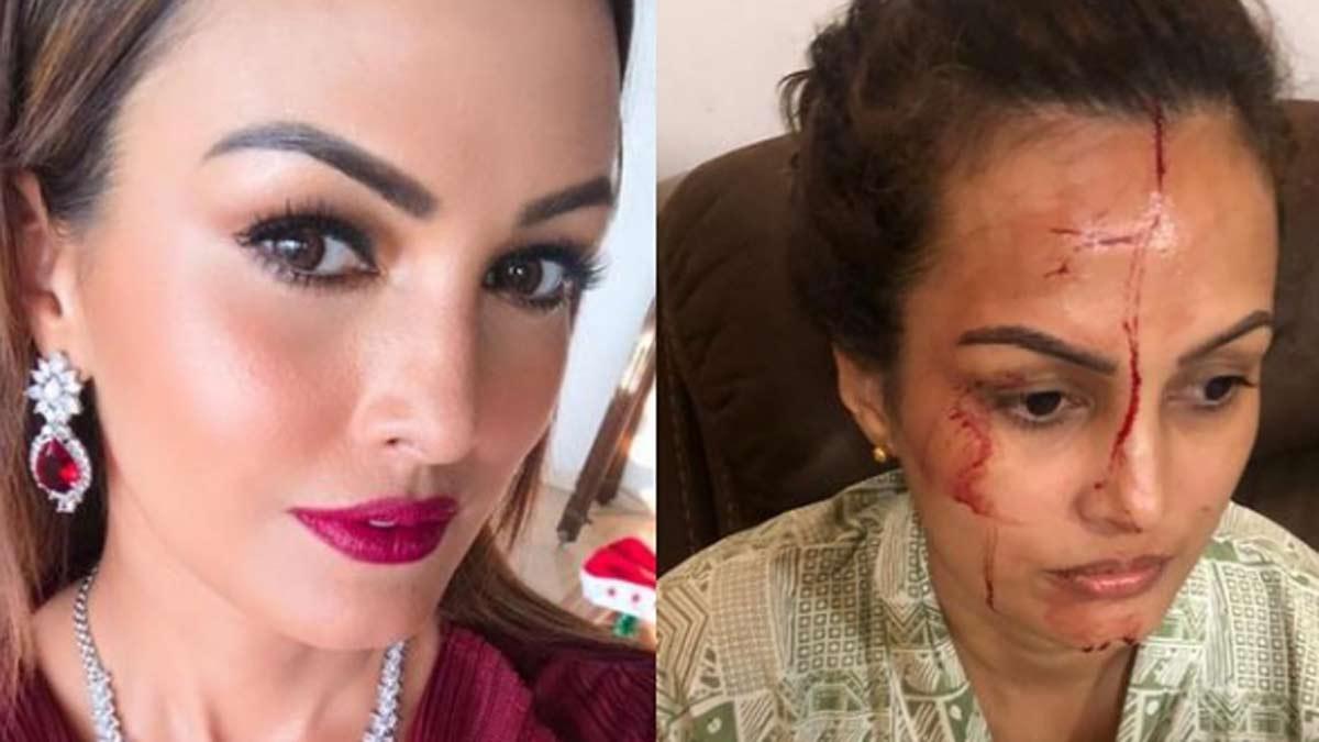 माथे पर चोट, चेहरे पर बहता खून, वायरल हो रही निशा रावल की ये दर्दनाक फोटो