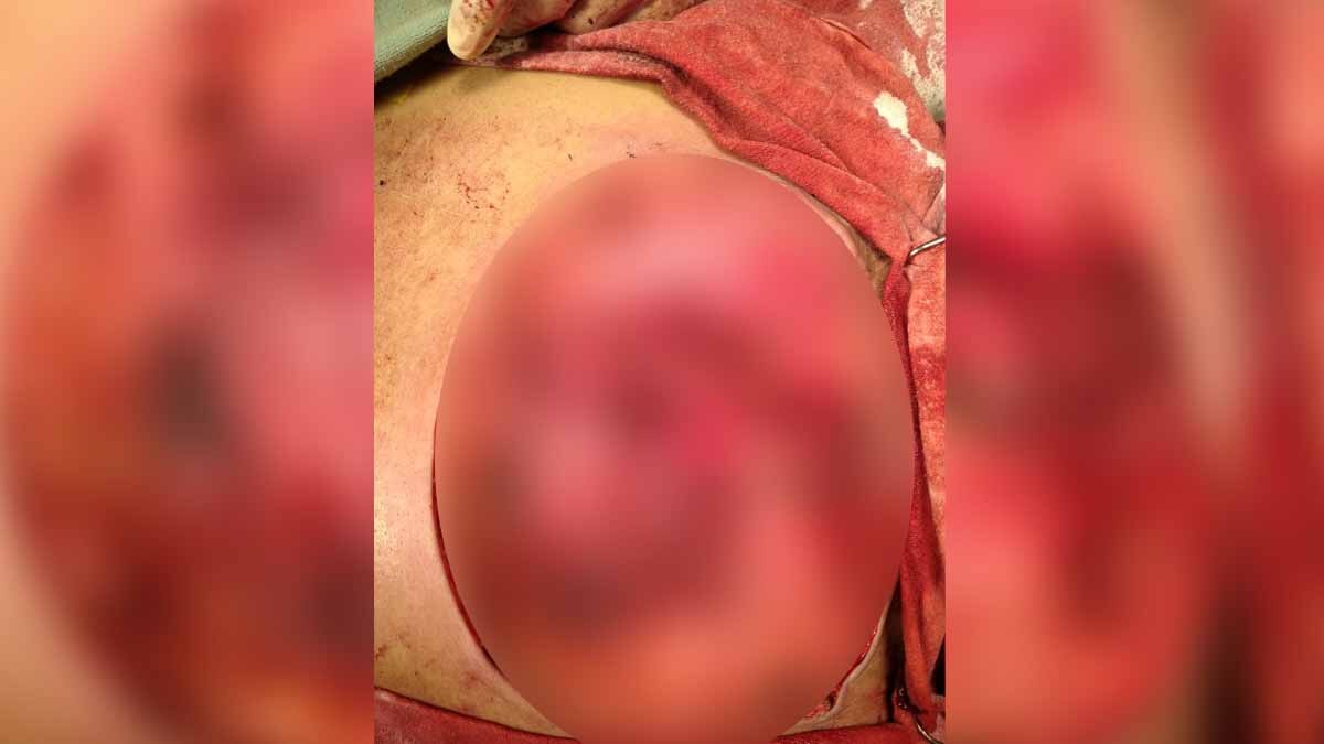 Gorakhpur Tumor Surgery