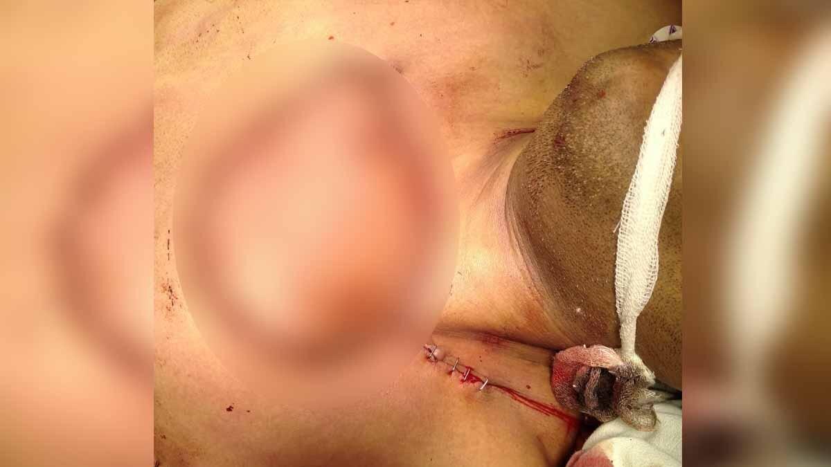 Gorakhpur Tumor Surgery