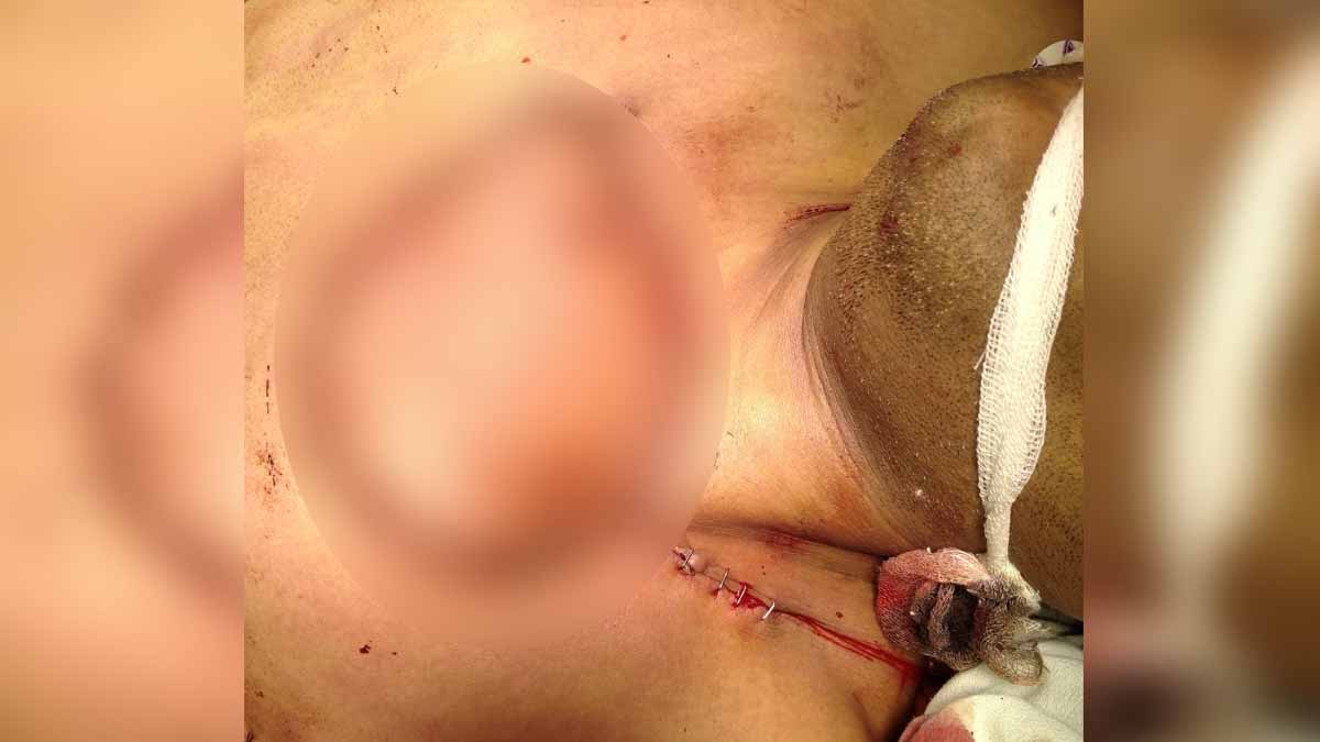 Gorakhpur Tumor Surgery