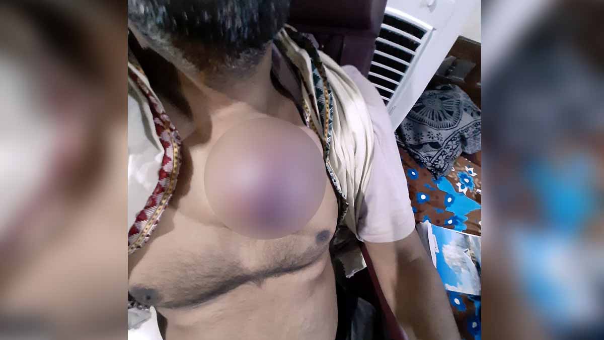 Gorakhpur Tumor Surgery