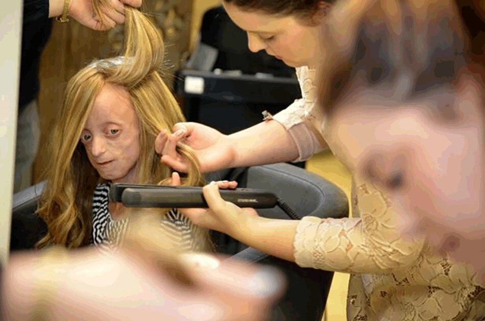 rare diesease progeria