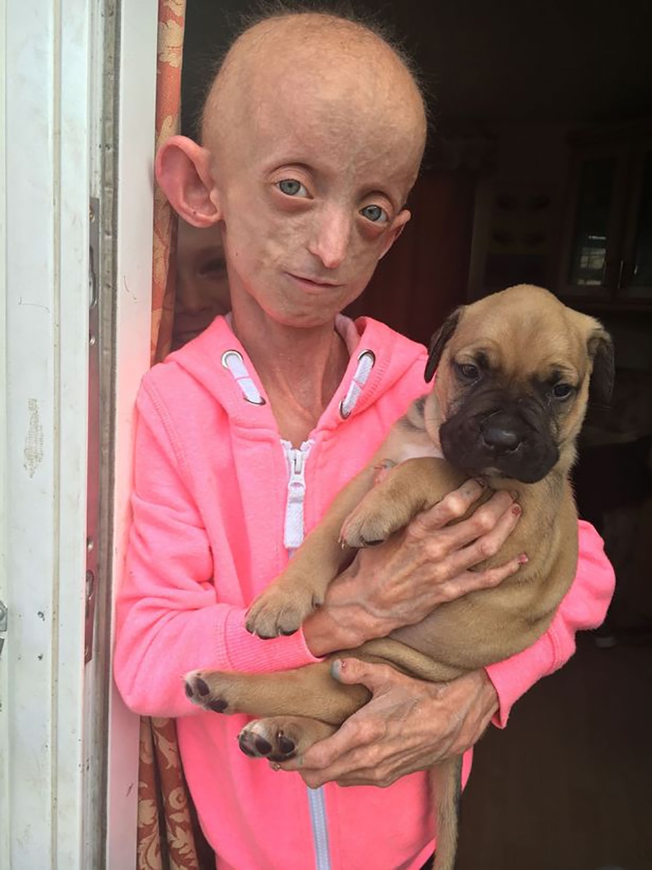 rare disease progeria