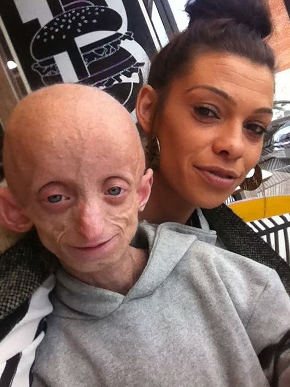 rare disease progeria