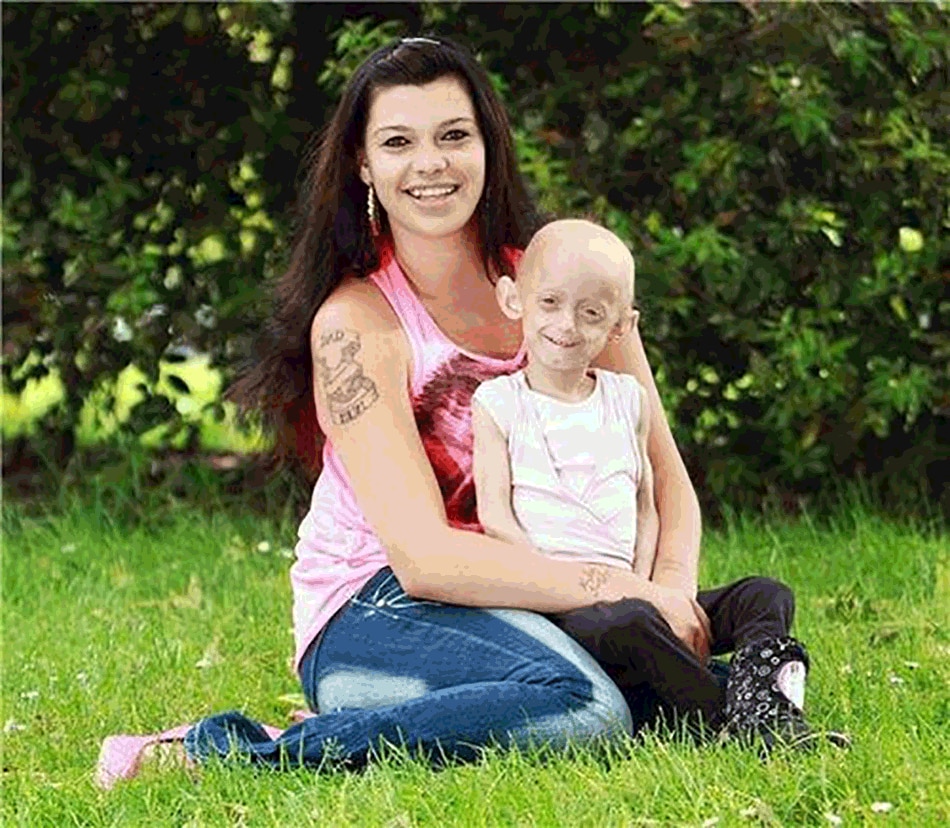 rare disease progeria