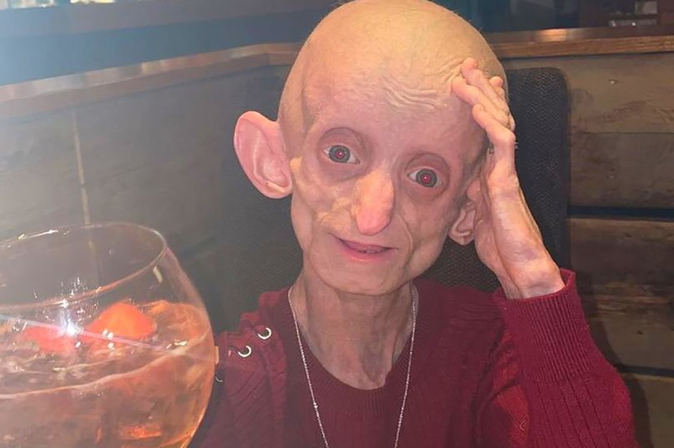 rare disease progeria
