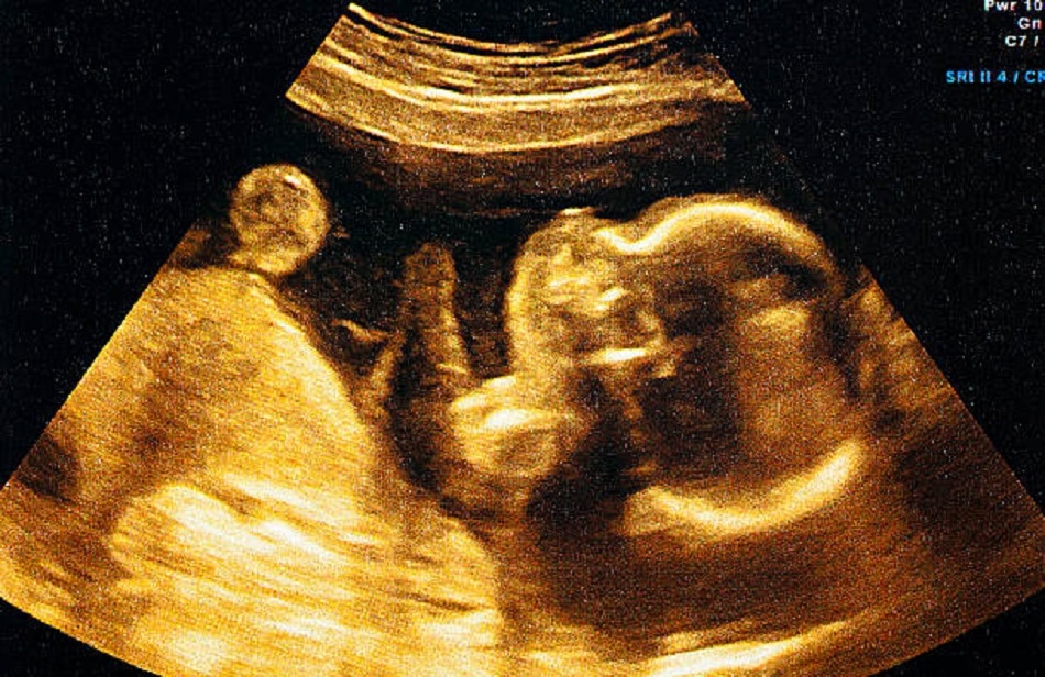 क्यों और कैसे पैदा होते हैं जुड़वां बच्चे?