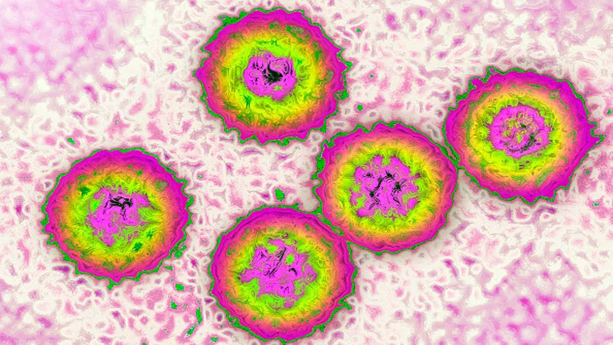 cytomegalovirus infection