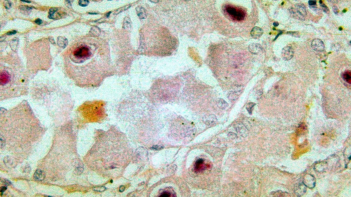 cytomegalovirus infection