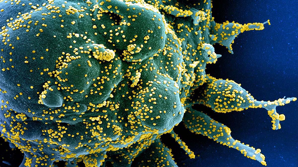 cytomegalovirus infection