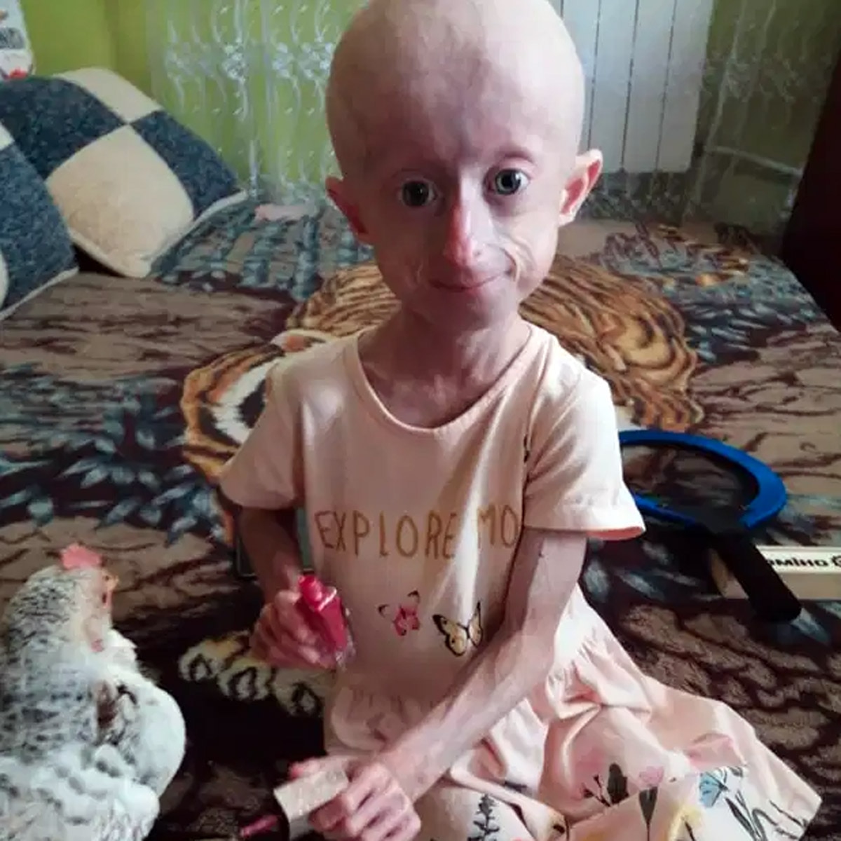 progeria disease