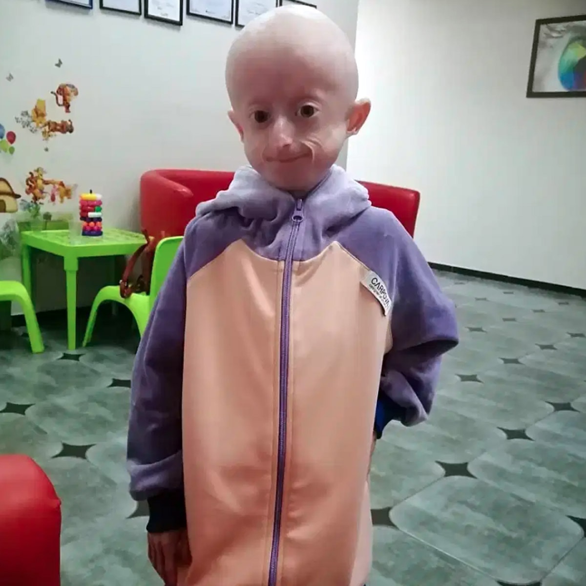 progeria disease