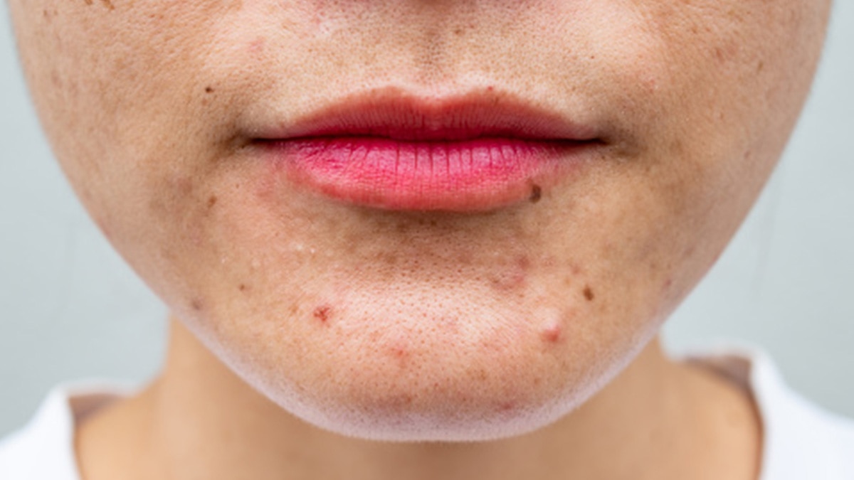 फोड़े-फुंसी का खतरा