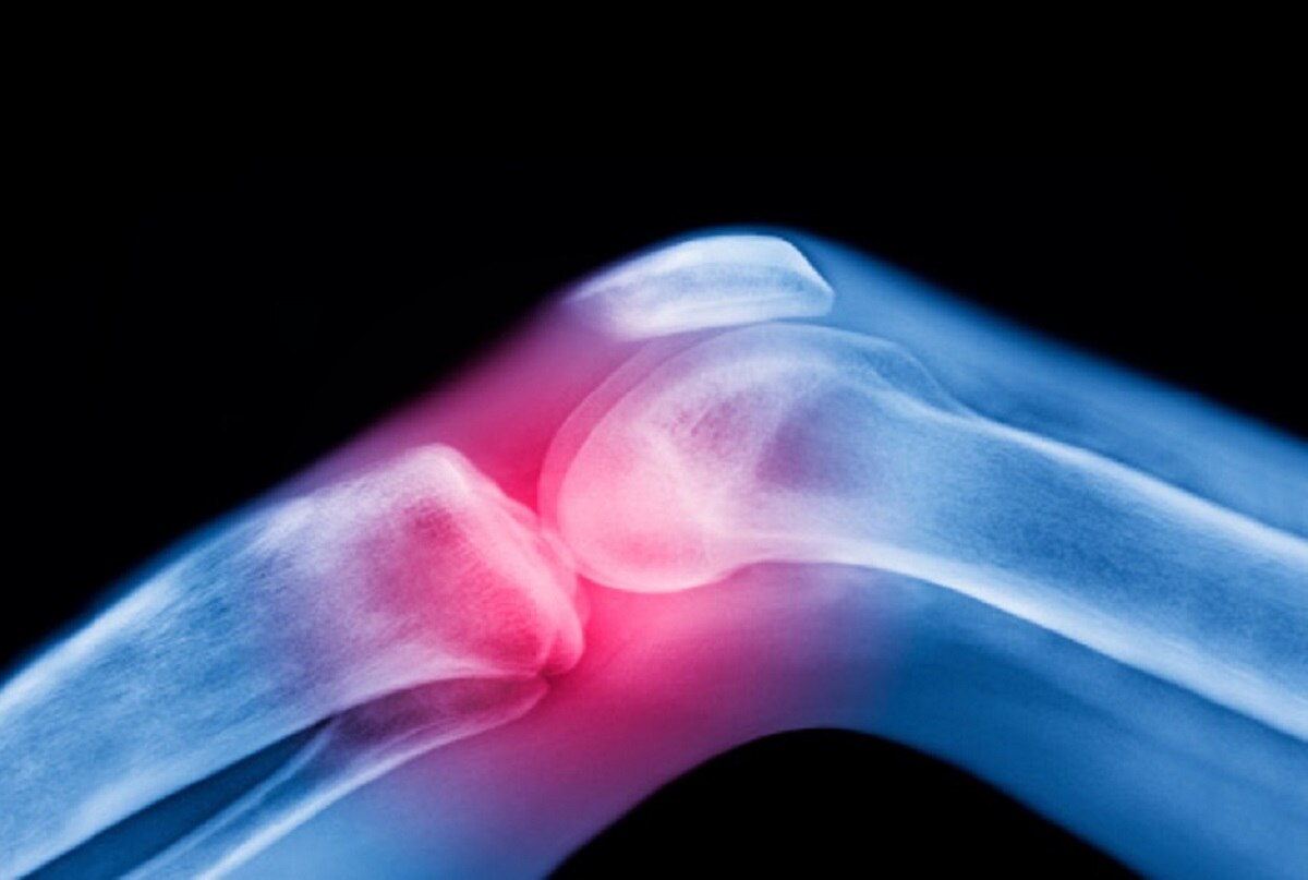 एवैस्क्लुर नेक्रोसिस