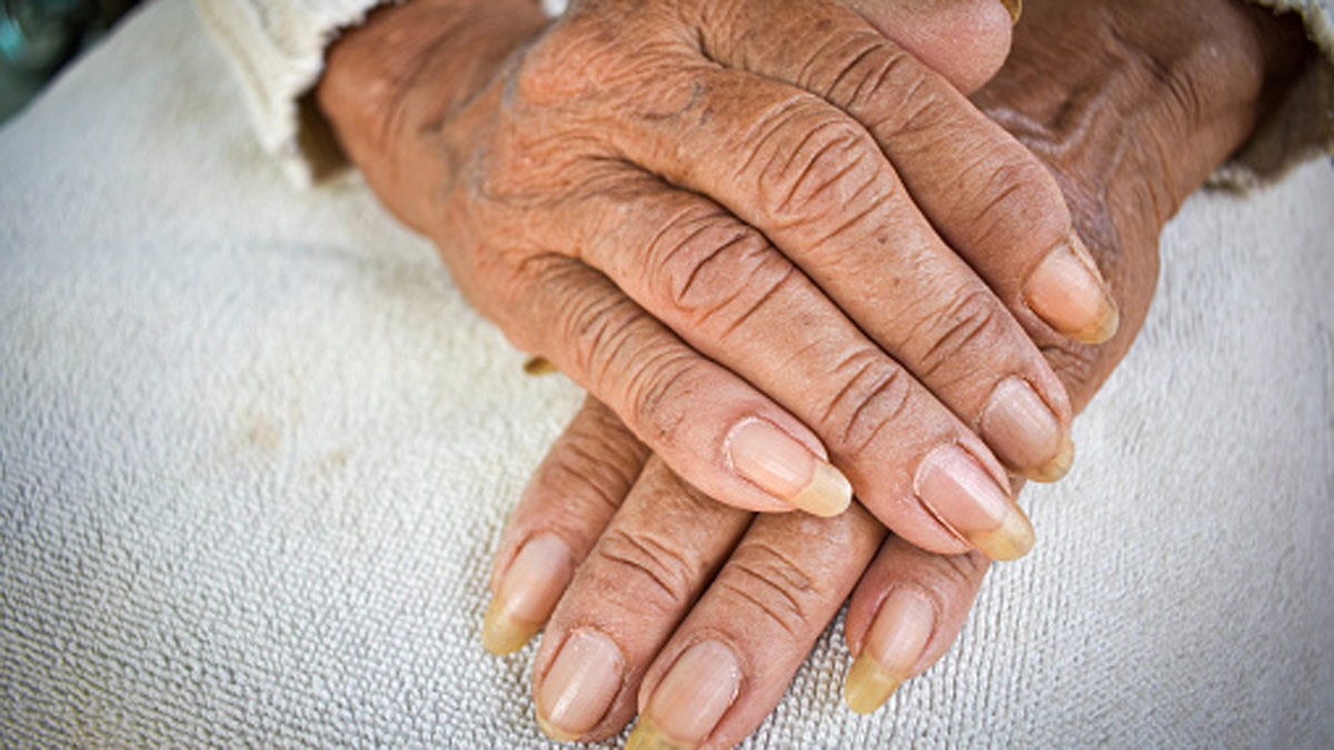 नाखून में गड्ढे बनना