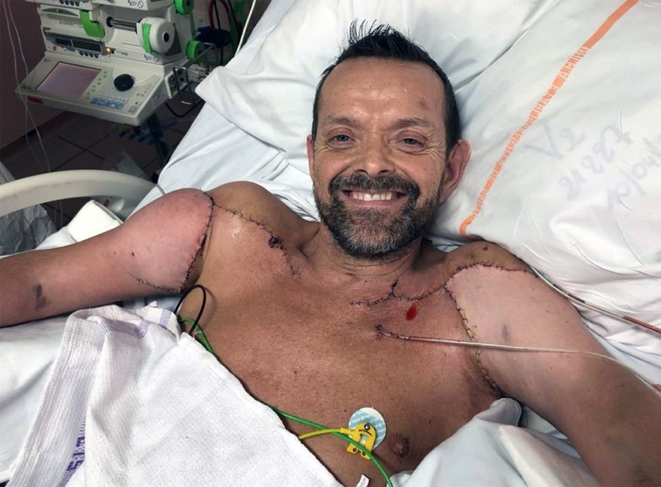 First double hand surgery