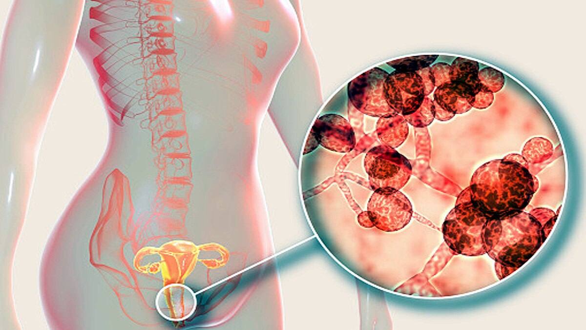 Superbug Fungus in US