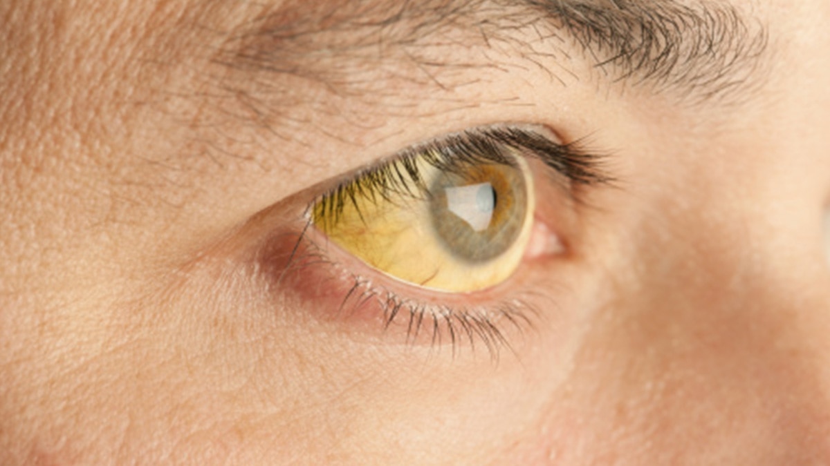 स्किन का पीला होना