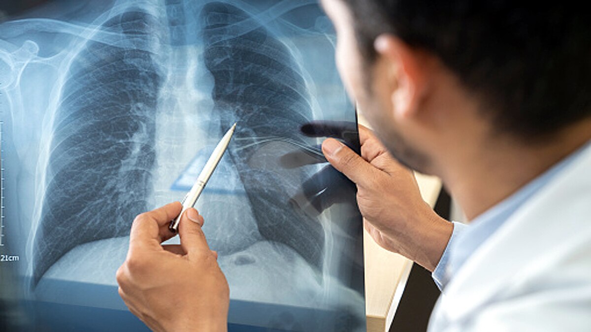 Covid-19 Severity with Age