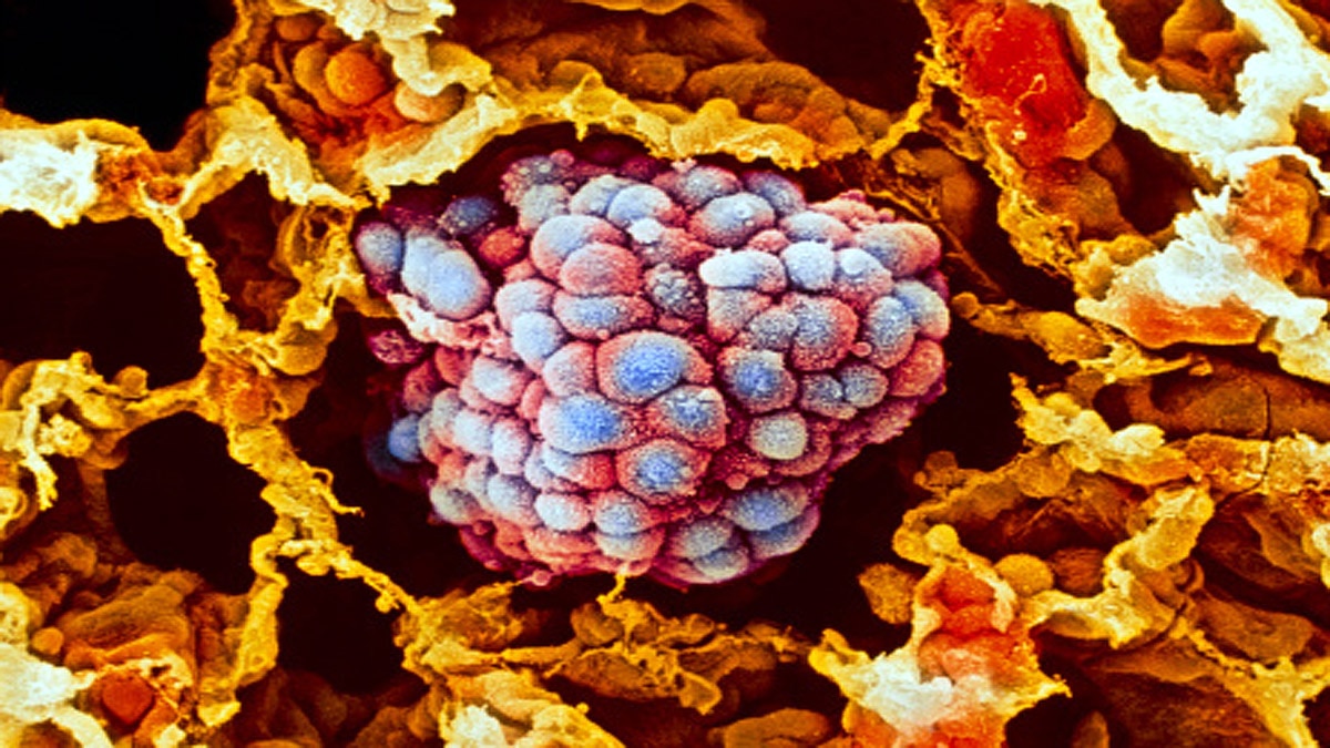 Excess Peanut Eating Causes Cancer