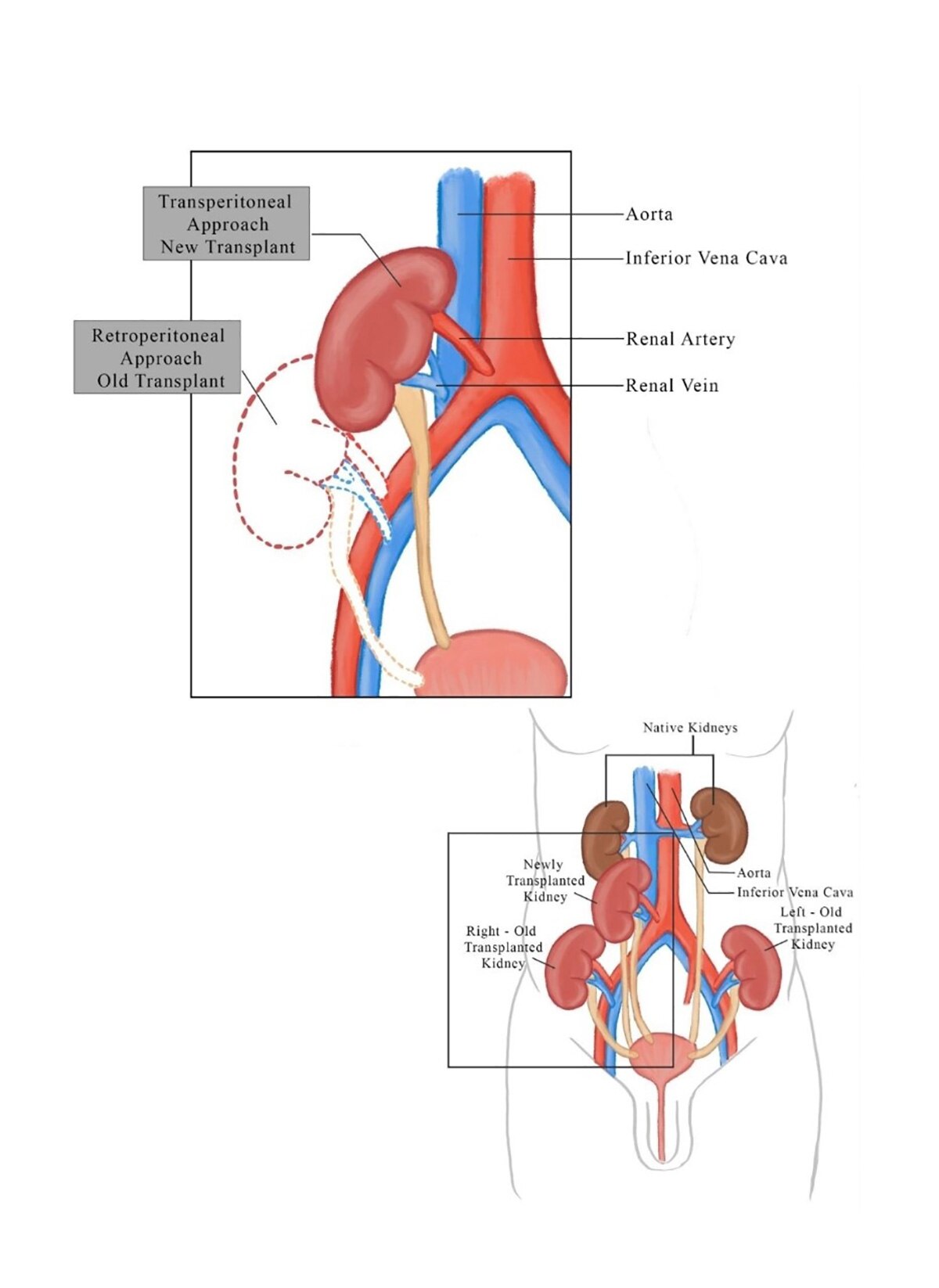 Kidney Transplant Chennai