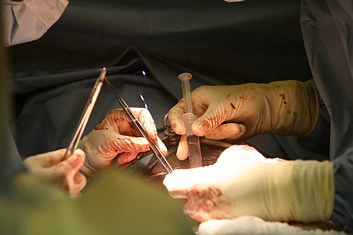 Kidney Transplant Chennai