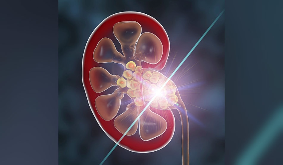किडनी6