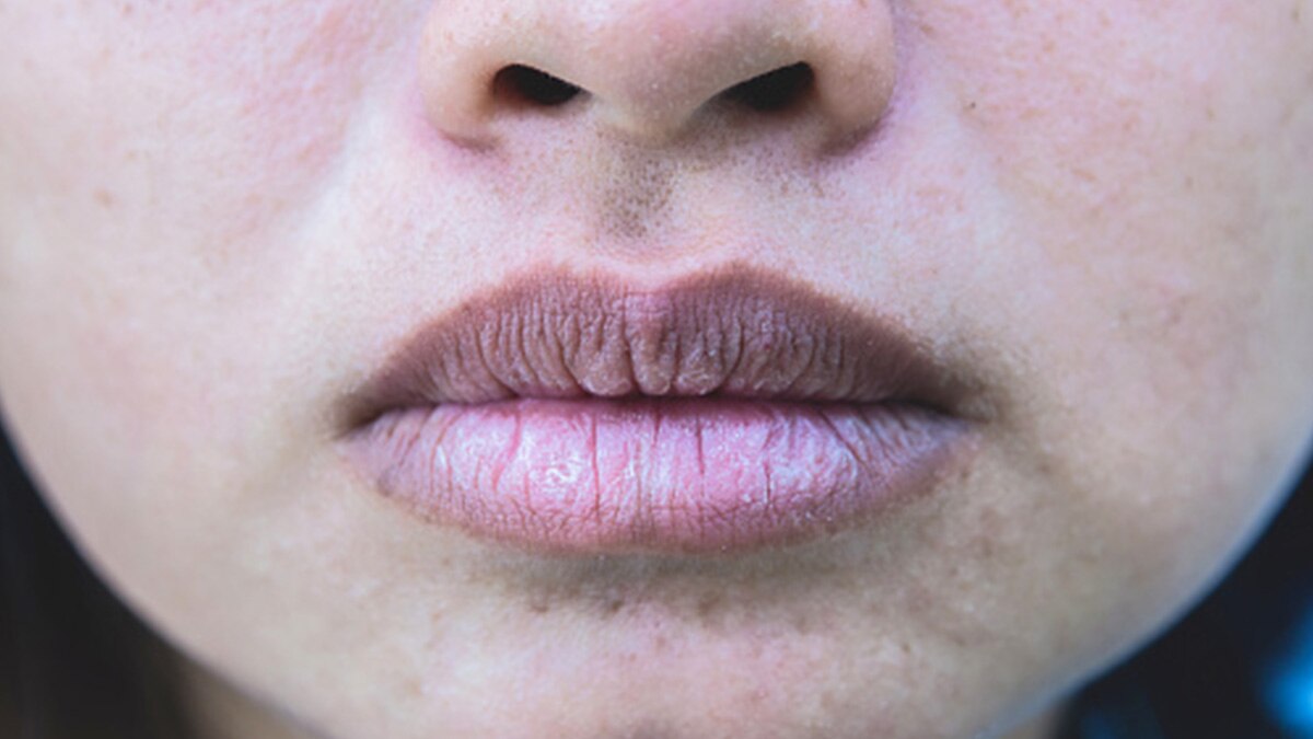 रूखी त्वचा