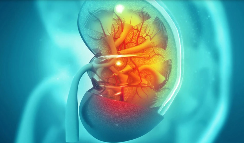 किडनी स्टोन2