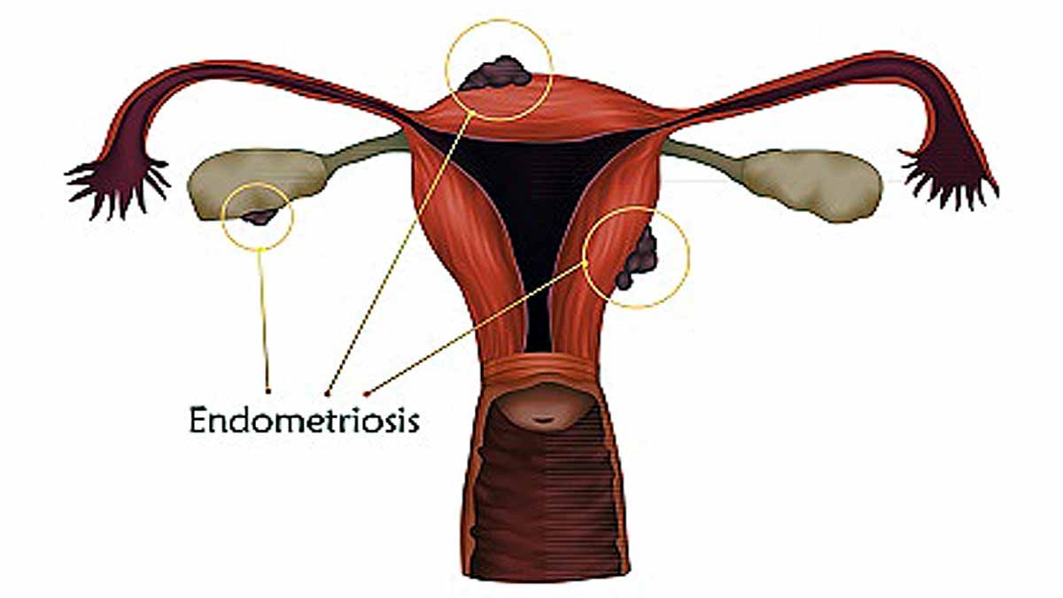 Treatment for endometriosis