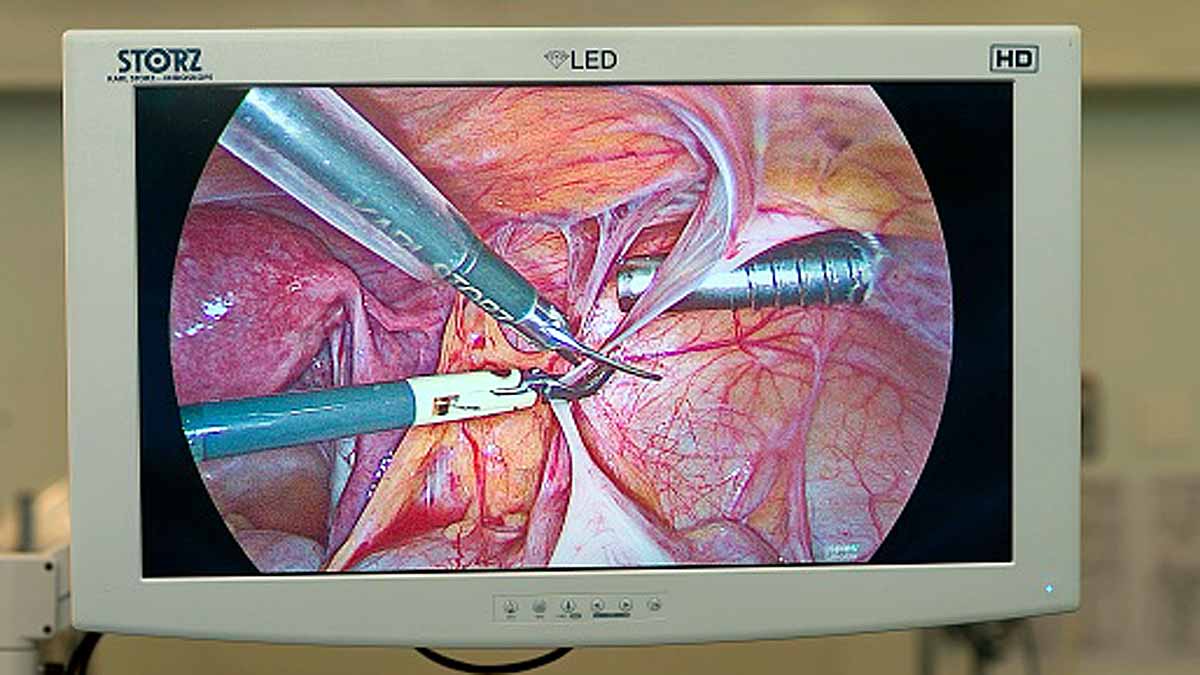 Treatment for endometriosis