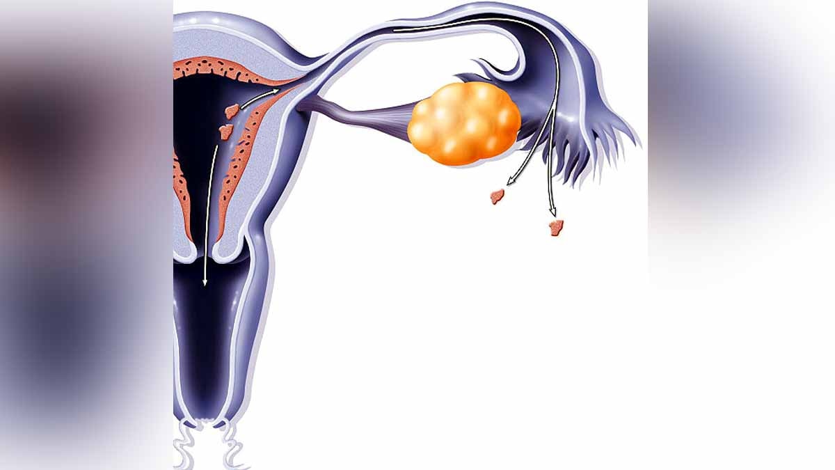 Treatment for endometriosis