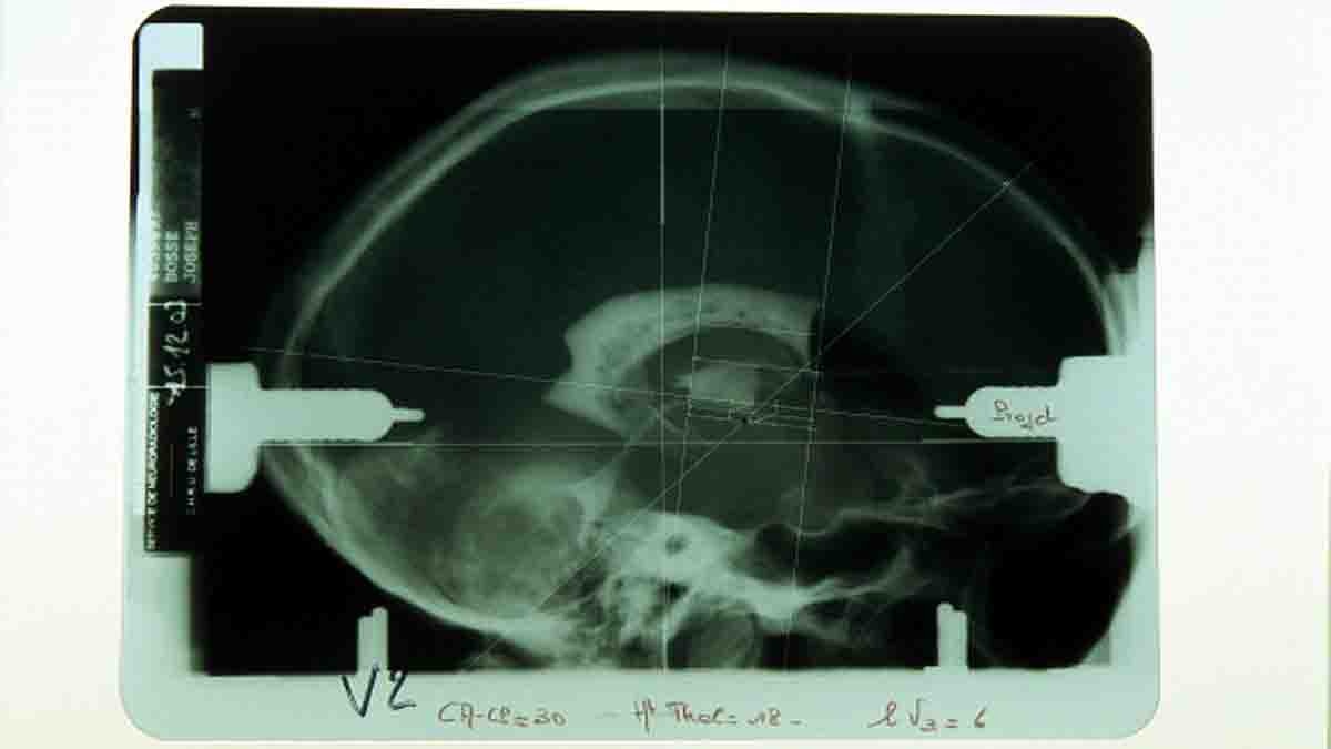 Blind Patient Brain Implant