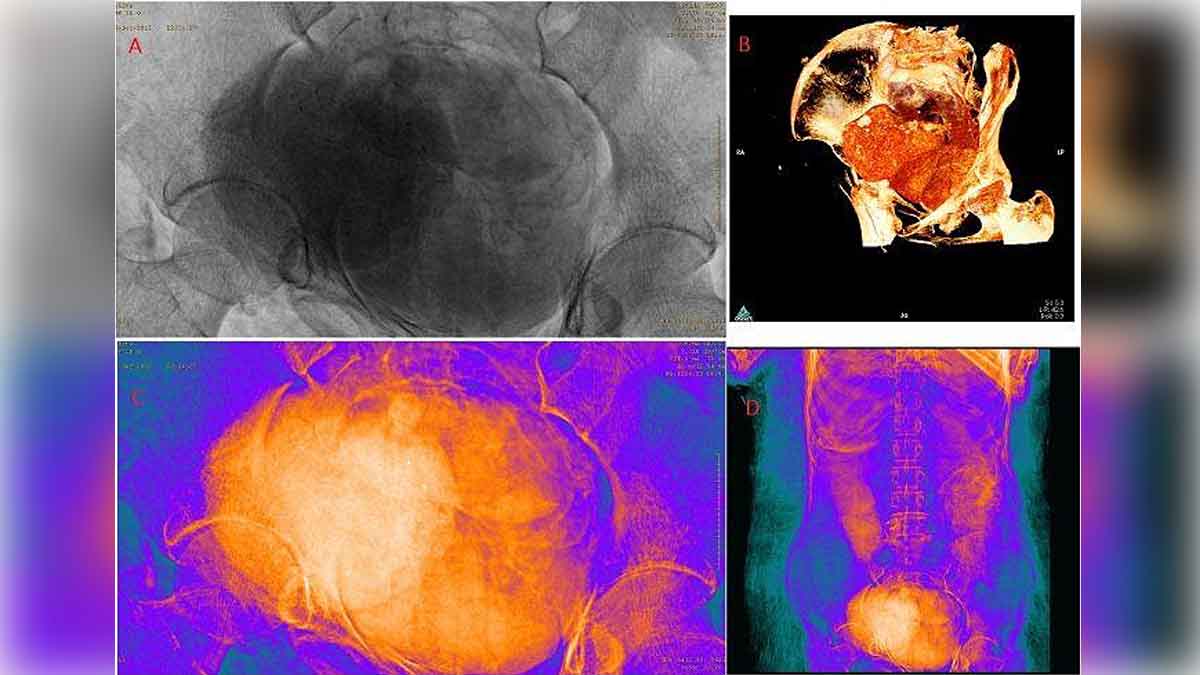 Egyptian Mummy Fetus