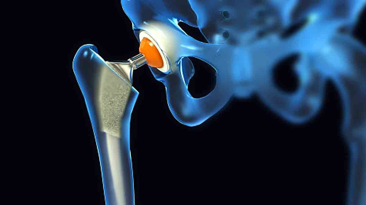 paralyzed men implant spinal cord