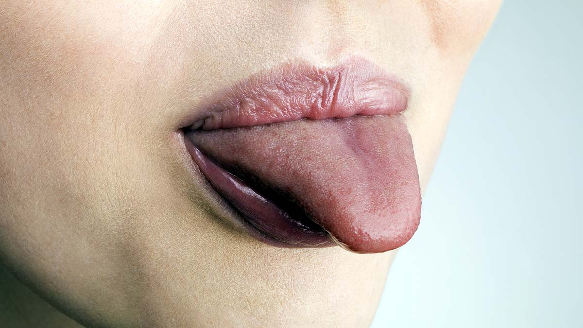 black hairy tongue syndrome