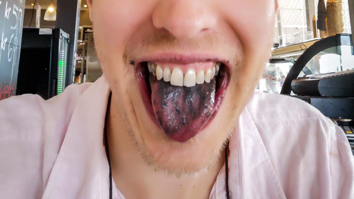 black hairy tongue syndrome