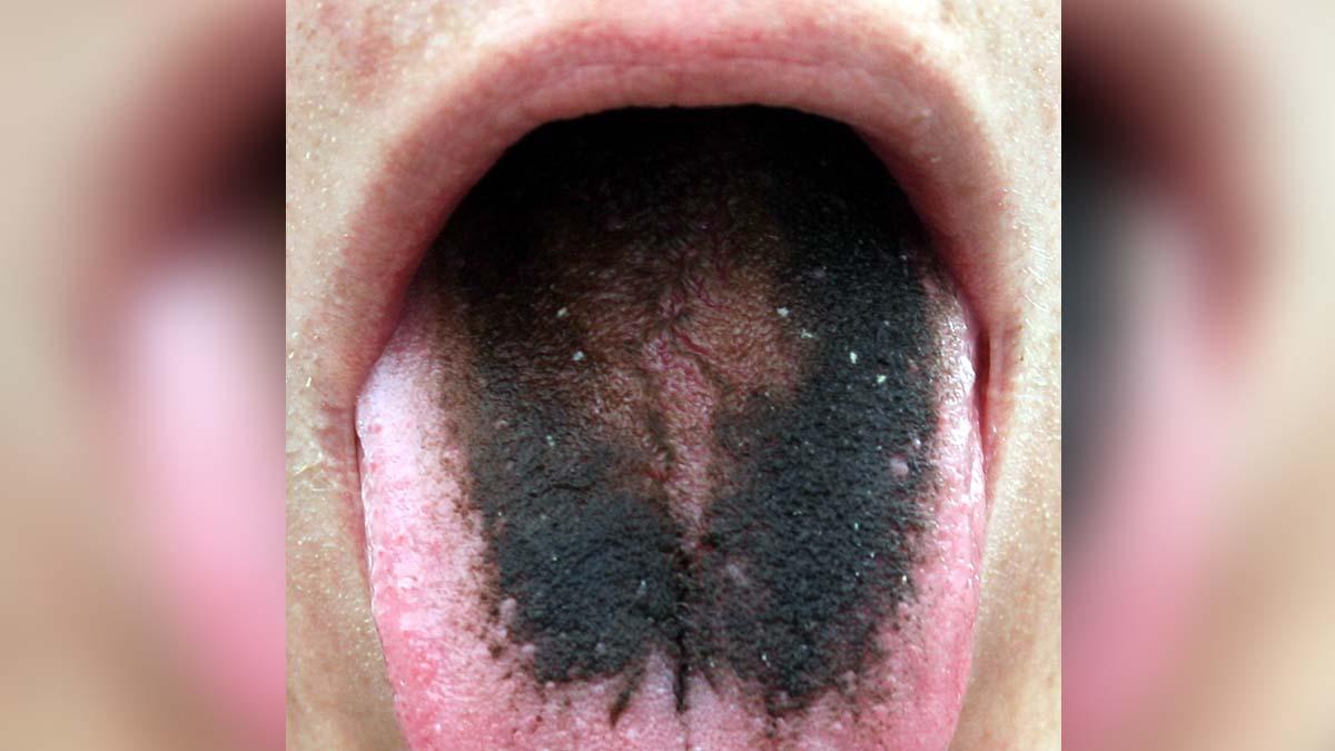 man has rare black hairy tongue syndrome cases treatment images