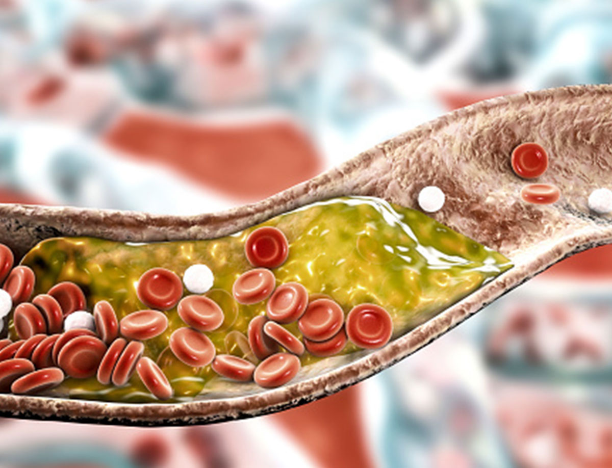 हाई कोलेस्ट्रॉल