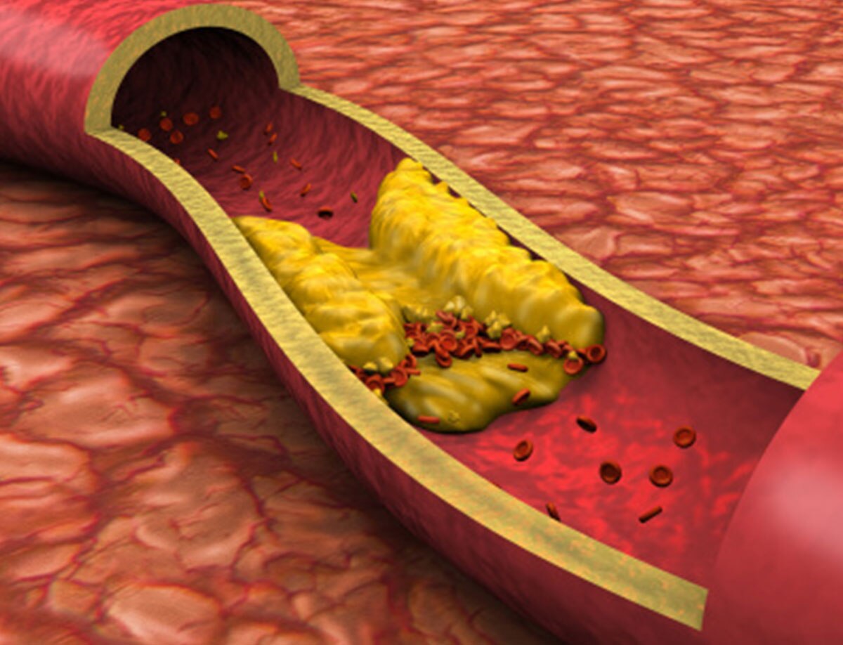 हाई कोलेस्ट्रॉल