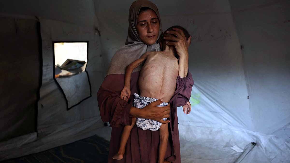 Gaza malnourished Children 