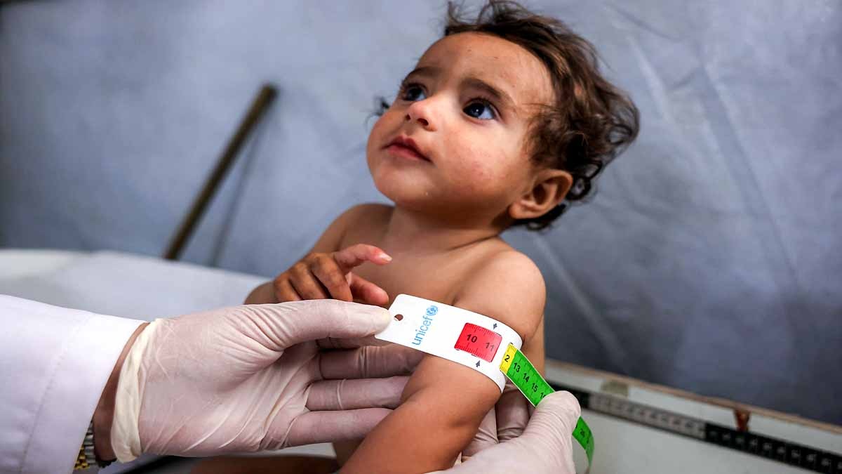 Gaza malnourished Children 