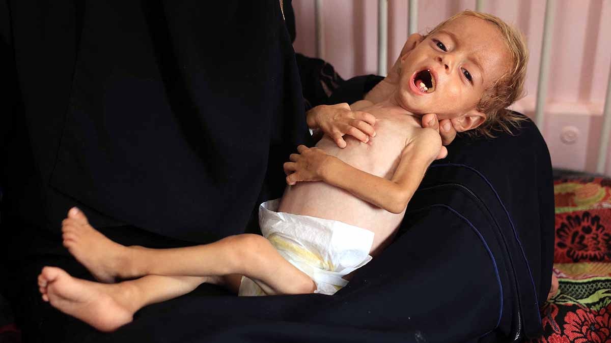 Gaza malnourished Children 