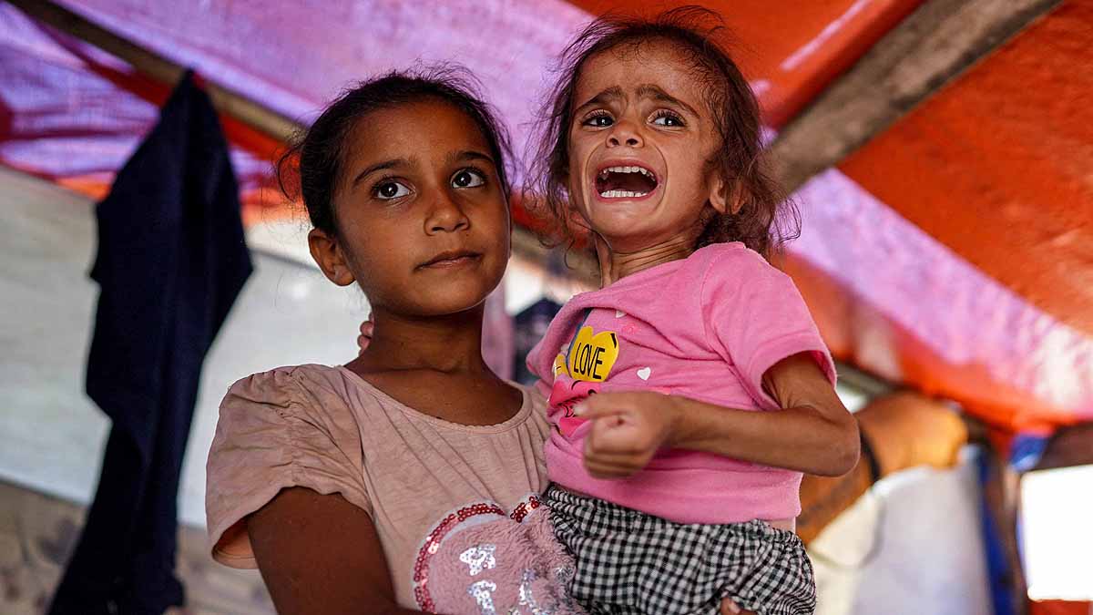 Gaza malnourished Children 