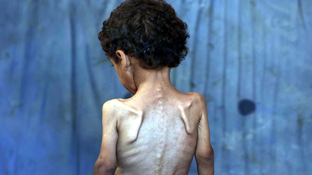 Gaza malnourished Children 