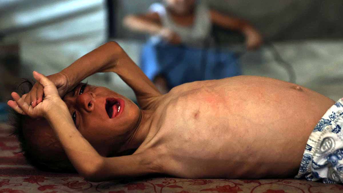Gaza malnourished Children 