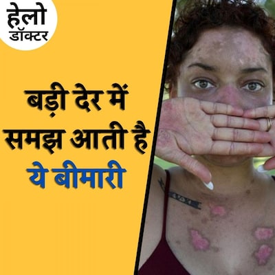 सामान्य लक्षणों वाली बेहद ख़तरनाक बीमारी है लुपस, जानिए क्या हैं इसके लक्षण: हेलो डॉक्टर, Ep 54