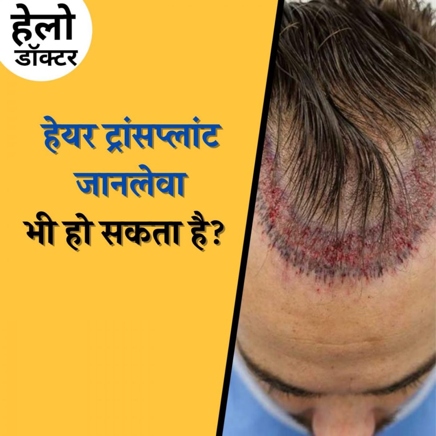 हेयर ट्रांसप्लांट करवाने के बारे में सोच रहे हैं तो ये ज़रूर सुनिए : हेलो डॉक्टर, Ep 110 हेयर ट्रांसप्लांट करवाने के बारे में सोच रहे हैं तो ये ज़रूर सुनिए : हेलो डॉक्टर, Ep 110